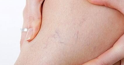 Die Anfangsphase der Krampfadern an den Beinen