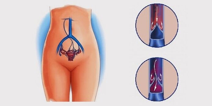 Warum entstehen Krampfadern im Beckenbereich