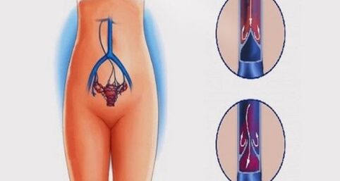 Anatomie der weiblichen Geschlechtsorgane und Venen, die von Krampfadern im Becken betroffen sind